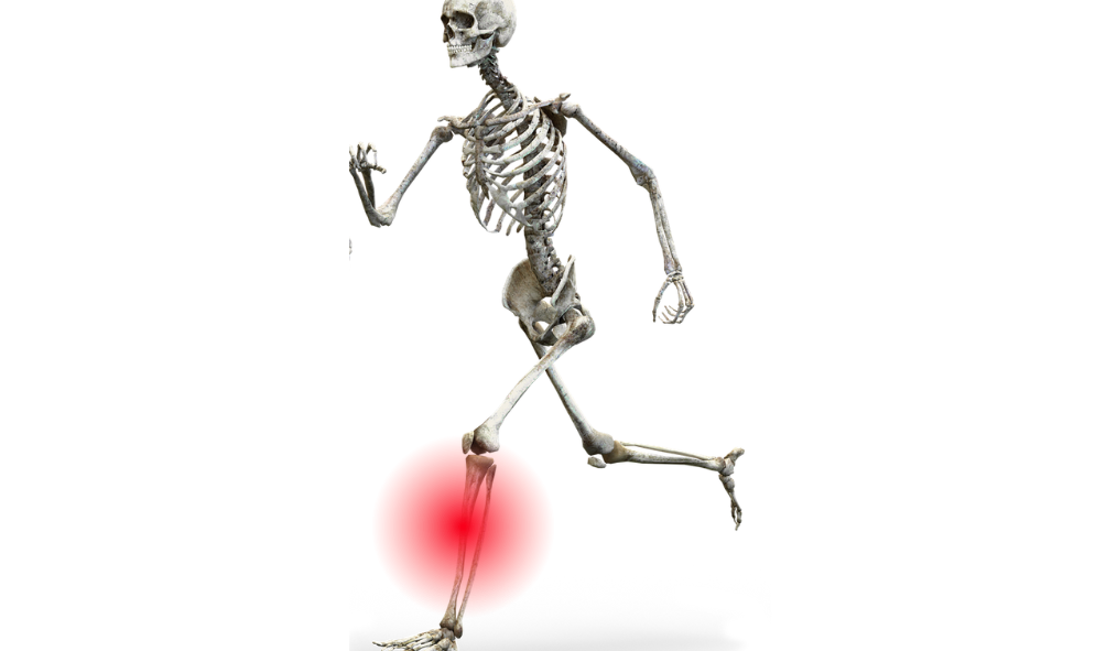 Periostitis tibial y osteopatía