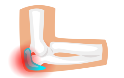Bursitis olecraniana y osteopatía