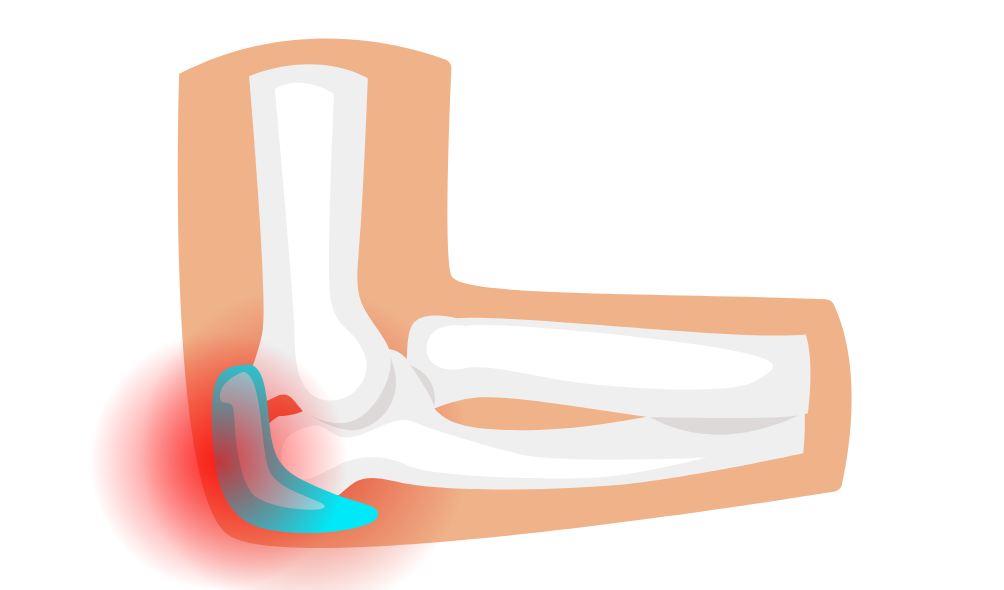 Tratamientos de osteopatía para la bursitis olecraniana Tratamientos de osteopatía para la bursitis olecraniana